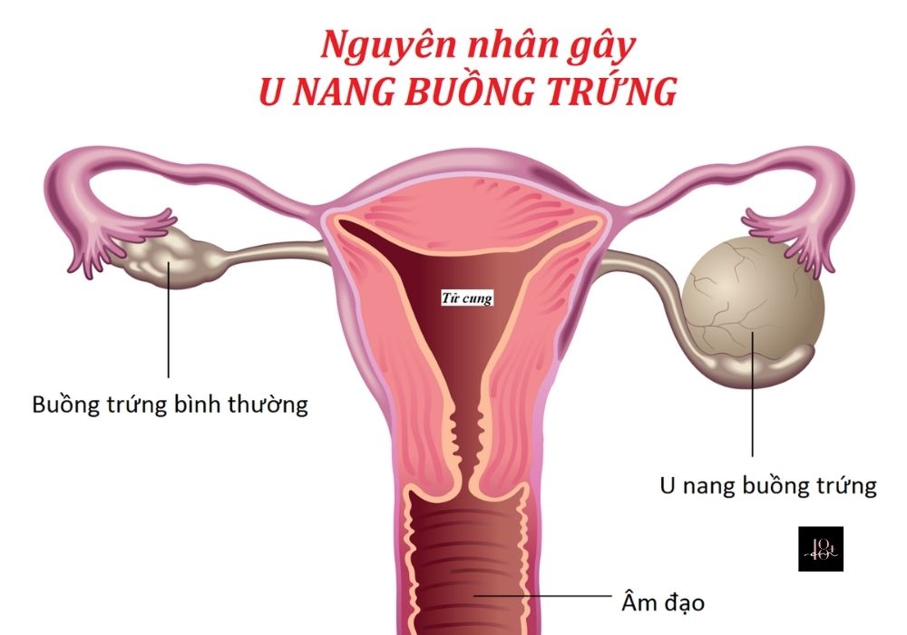 cham-soc-vung-kin-u-nang-buong-trung
